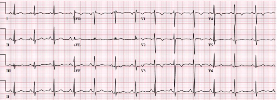 急诊心电图(无不适)示:窦性心律,v1-v4导联t波倒置.